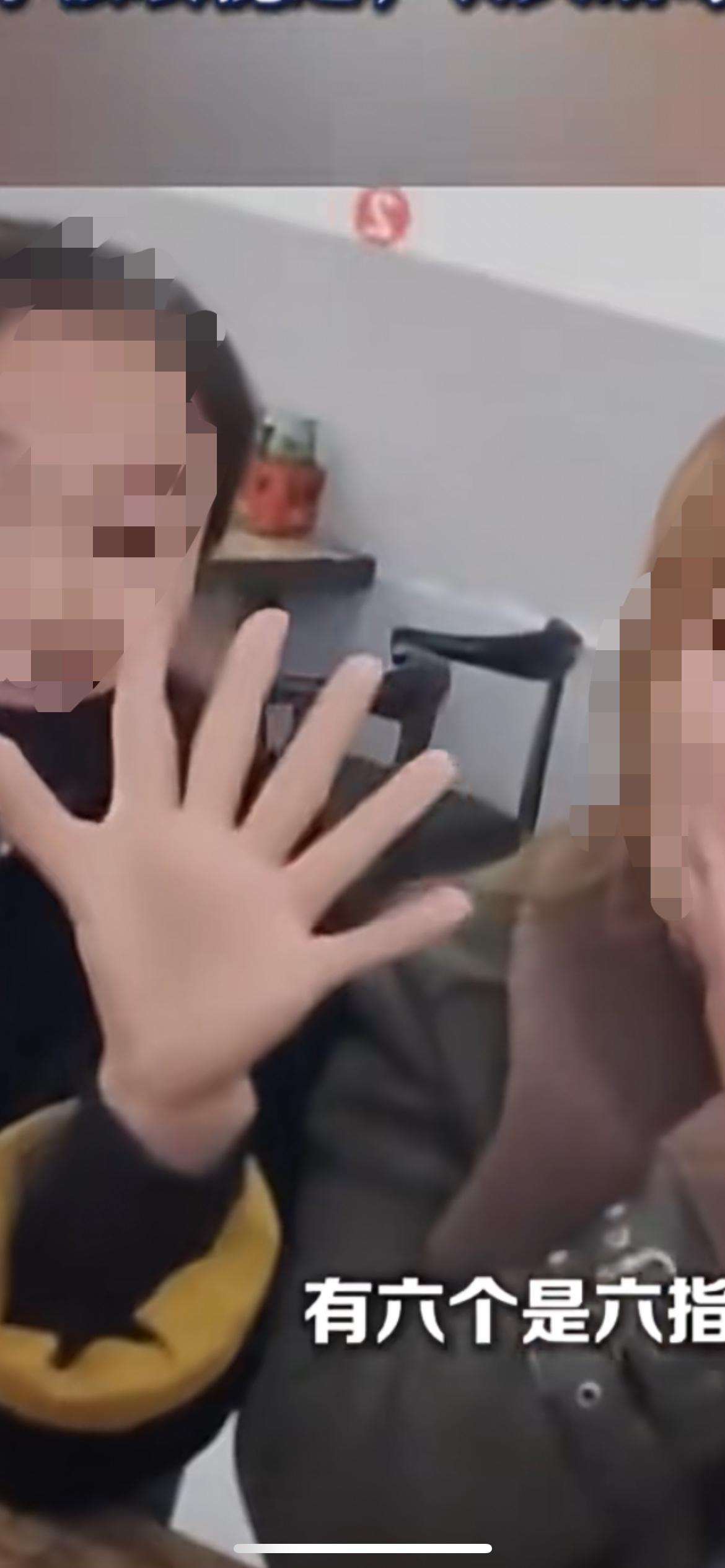 3月3日安徽宿州，女子天生有12根手指 ，我爸有6指，遗传了给我，获百万粉丝，家