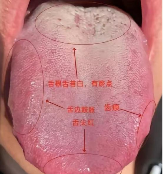 这种舌象寒热错杂，找出根源在哪，治疗效如桴鼓！
 
这位患者是典型的寒热错杂的舌