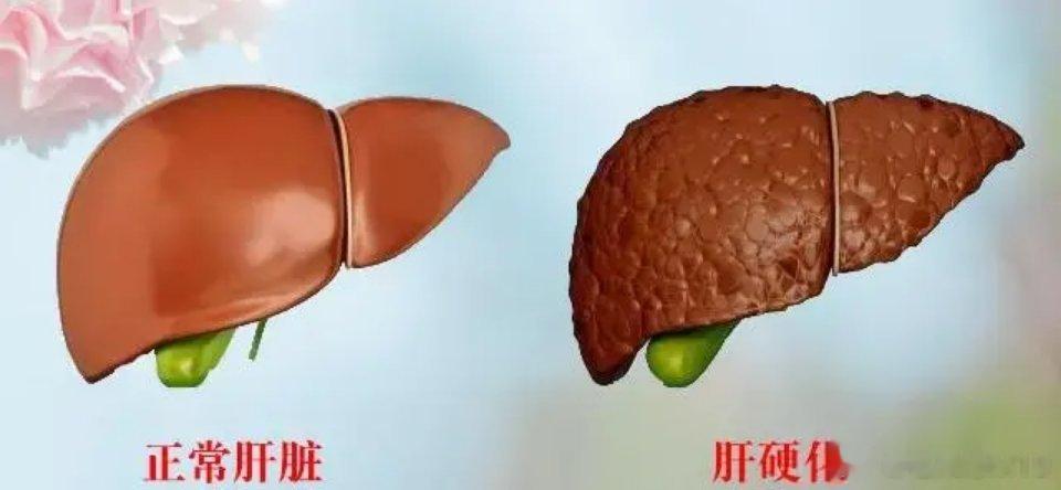 肝硬化代偿期的中医辨证治疗   1．肝郁脾虚主证：食欲减退，胸腹闷胀，嗳气不舒，