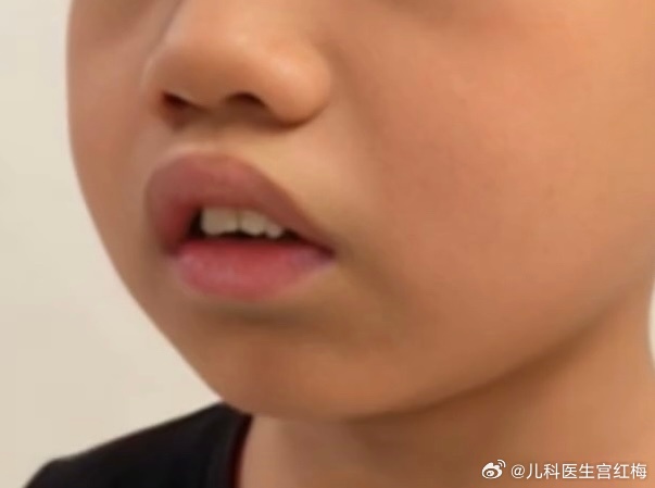 很多孩子出现张口呼吸、睡觉打呼噜，家长容易当成睡得香，其实要多加留意。长期张口睡