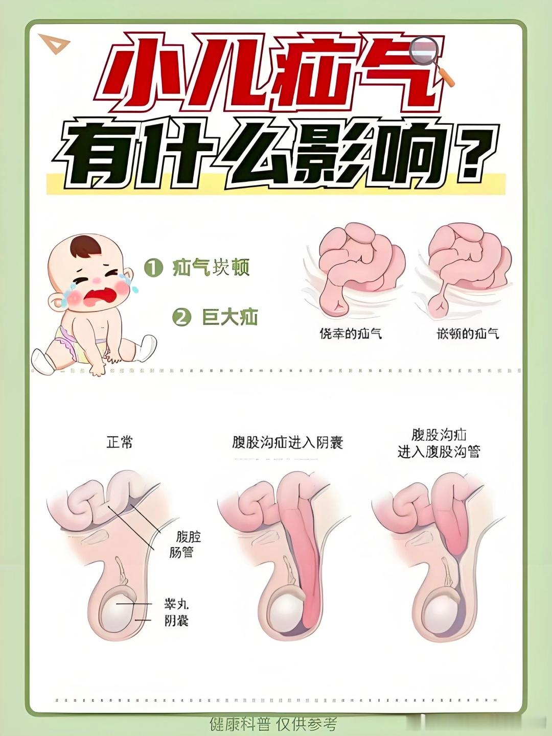 借着韩杰医生这件事，给大家简单的科普一下儿童嵌顿性疝气的相关知识。我年轻的时候在