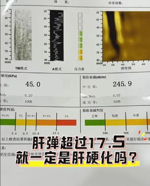 肝弹17.5以上一定是肝硬化吗？ 肝硬度值超过17.5kPa时，一般有...