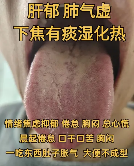 不拖延，你发我看，出结果不墨迹！ 1.肺气不足，痰湿化热，有心火 2....