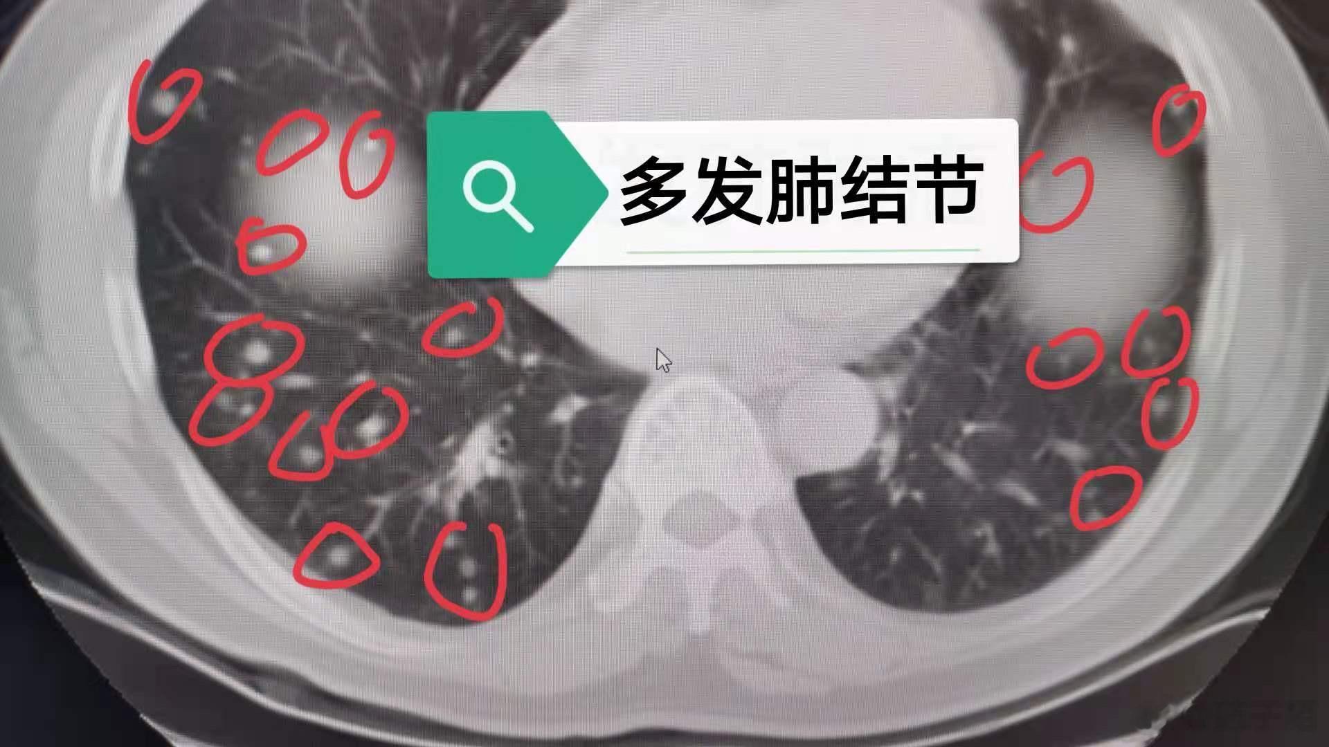 老中医张士舜的肺结节、乳腺结节、甲状腺结节经验方！摘要：张士舜，男，1939年生