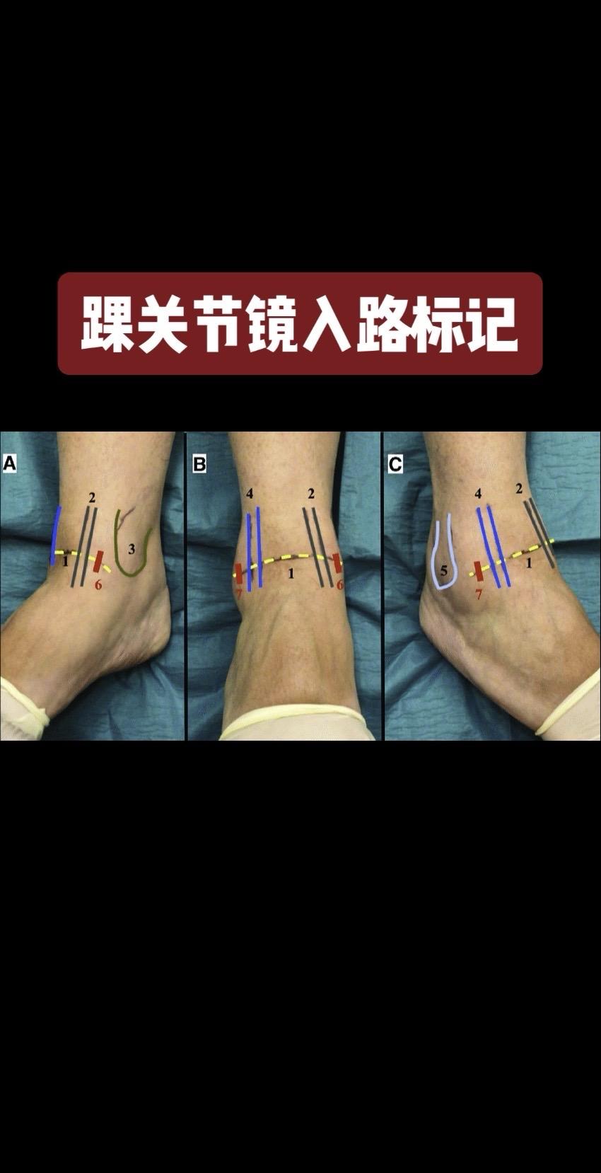 踝关节镜入路标记。踝关节镜的‘秘密通道’！🔍 这些标记点get了吗？