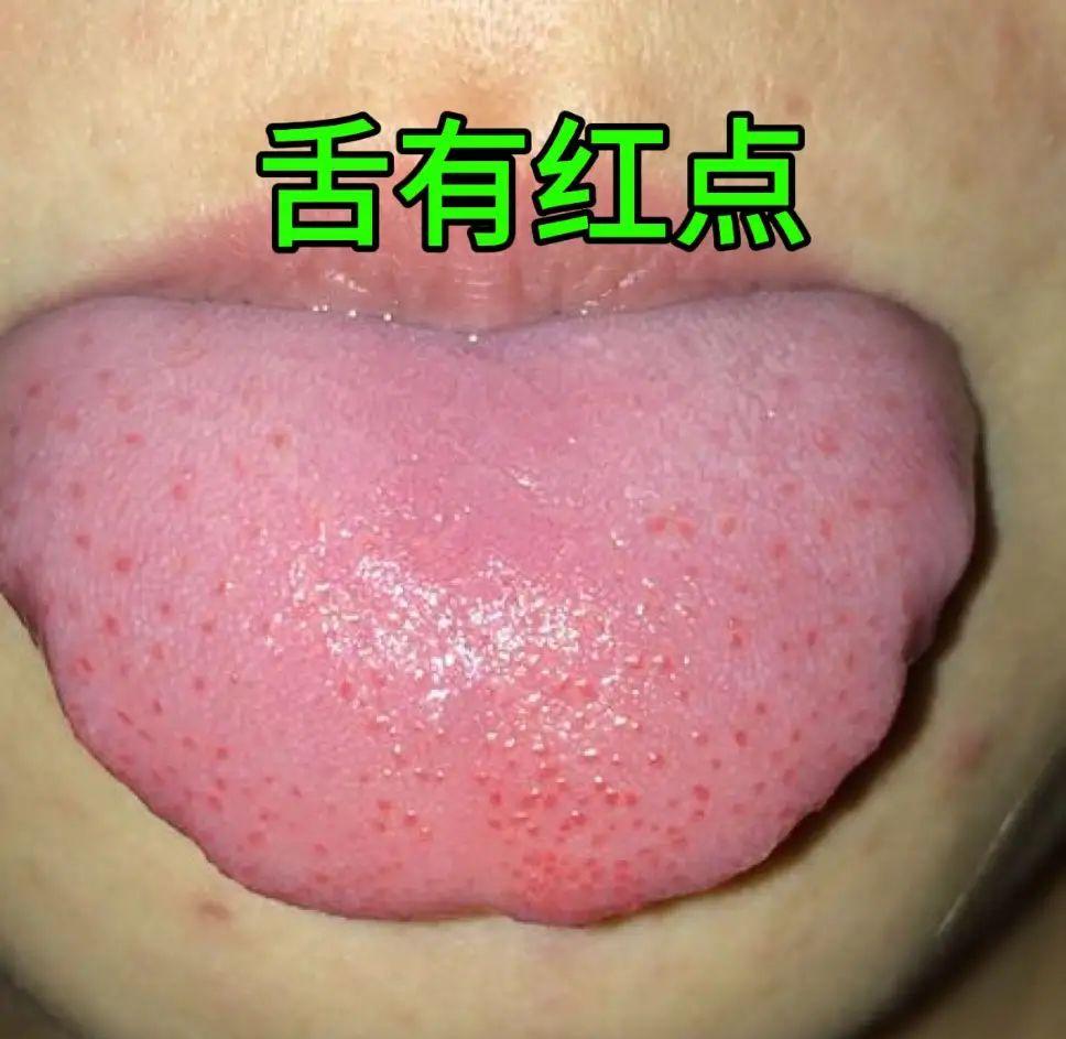 通过舌头形态洞察体质类型
舌头，作为我们品尝美食的重要器官，同时也是身体健康状况