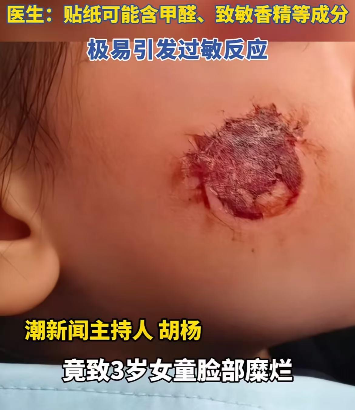 看了3 岁女童把电商低价贴纸，贴在脸上面部出现溃烂
我等不及下班了，马上回家第一