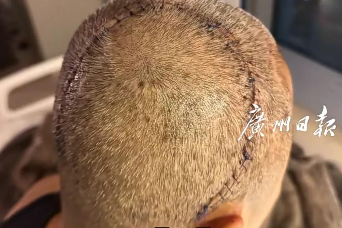 草蜢乐队 成员：蔡一杰 发文称已切除脑部肿瘤，网友：祝愿早日康复 ！

蔡一杰1