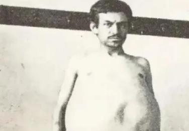 1940年，一位美国男子正在排泄大便时突然死亡，当法医检查过后发现男子体内竟然堆