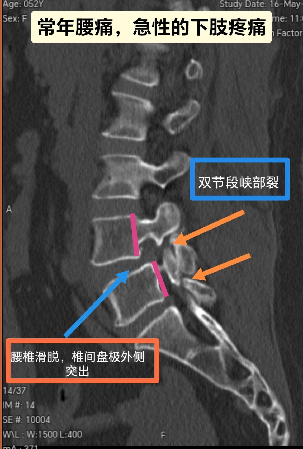 峡部裂滑脱治疗。