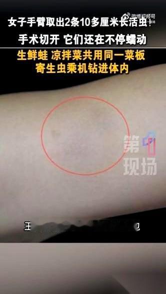 深圳王女士手臂上那个包，疼了一年。
医生一刀划开，没流血，没出脓，反倒慢悠悠钻出