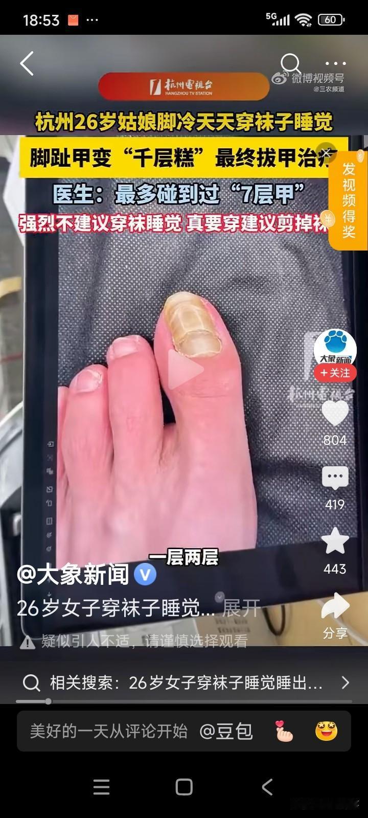 浙江杭州，有位26岁的女子睡觉爱穿袜子。
最近，女子发现自己的脚趾甲长成了一层一