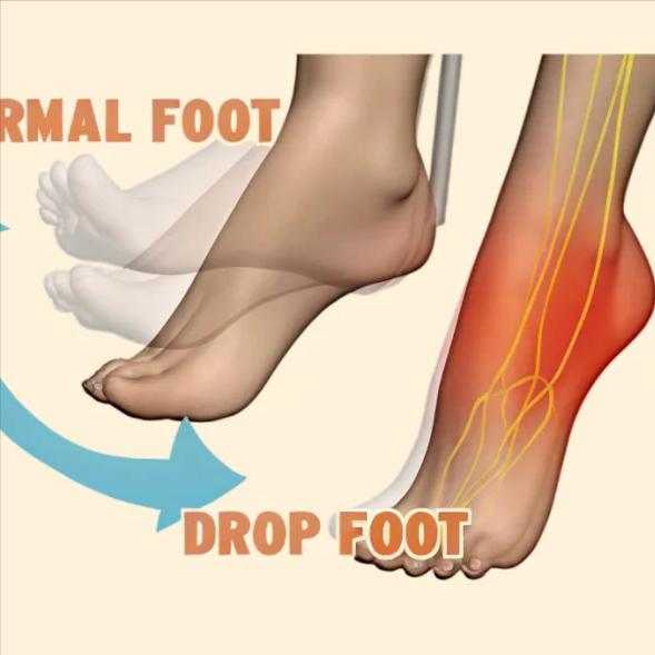 足下垂别大意！教你4个改善方法，走路更稳当
今天查房时，又看到好几位患者在练习走