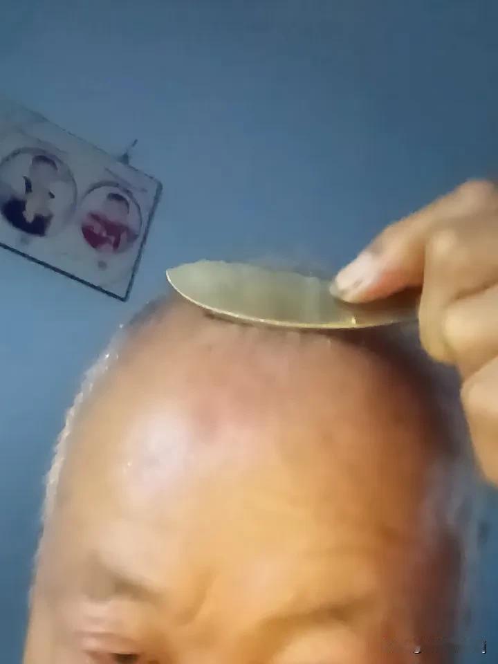刮痧时,刮出来的痧是什么? 刮痧时刮出来的痧，说是身体组织堆积的毒素，这说法有点