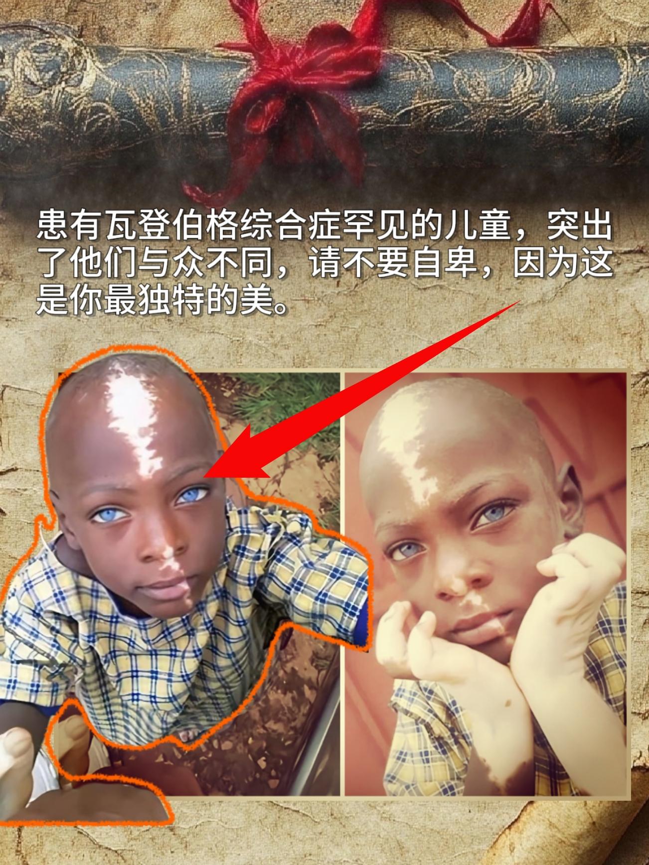 患有瓦登伯格综合症罕见的儿童，突出了他们与众不同，请不要自卑，因为这是...