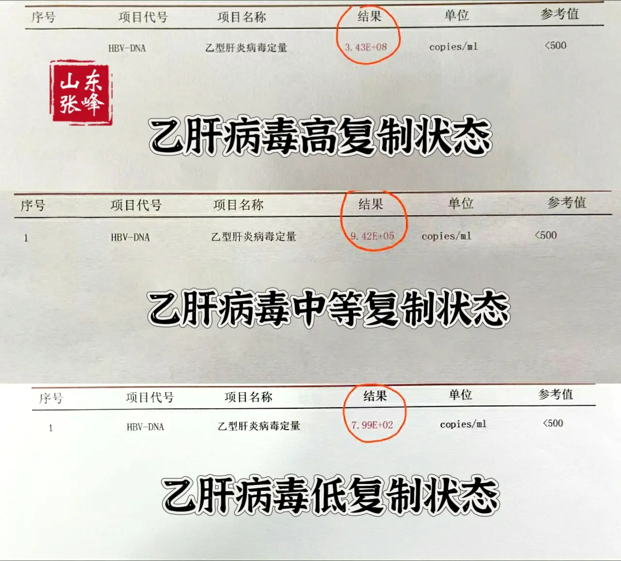 乙肝病毒量多高有危险？乙肝病毒量的高低并不能决定病情严重程度，病情的评...