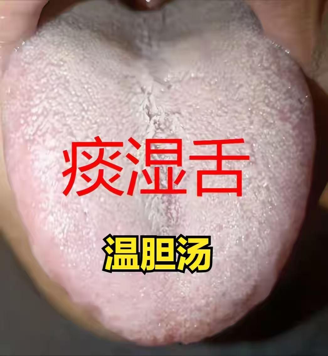 痰湿多梦易醒，肝郁睡眠断续，血虚睡不踏实！你又是哪种舌象呢？
很多人被睡眠问题困