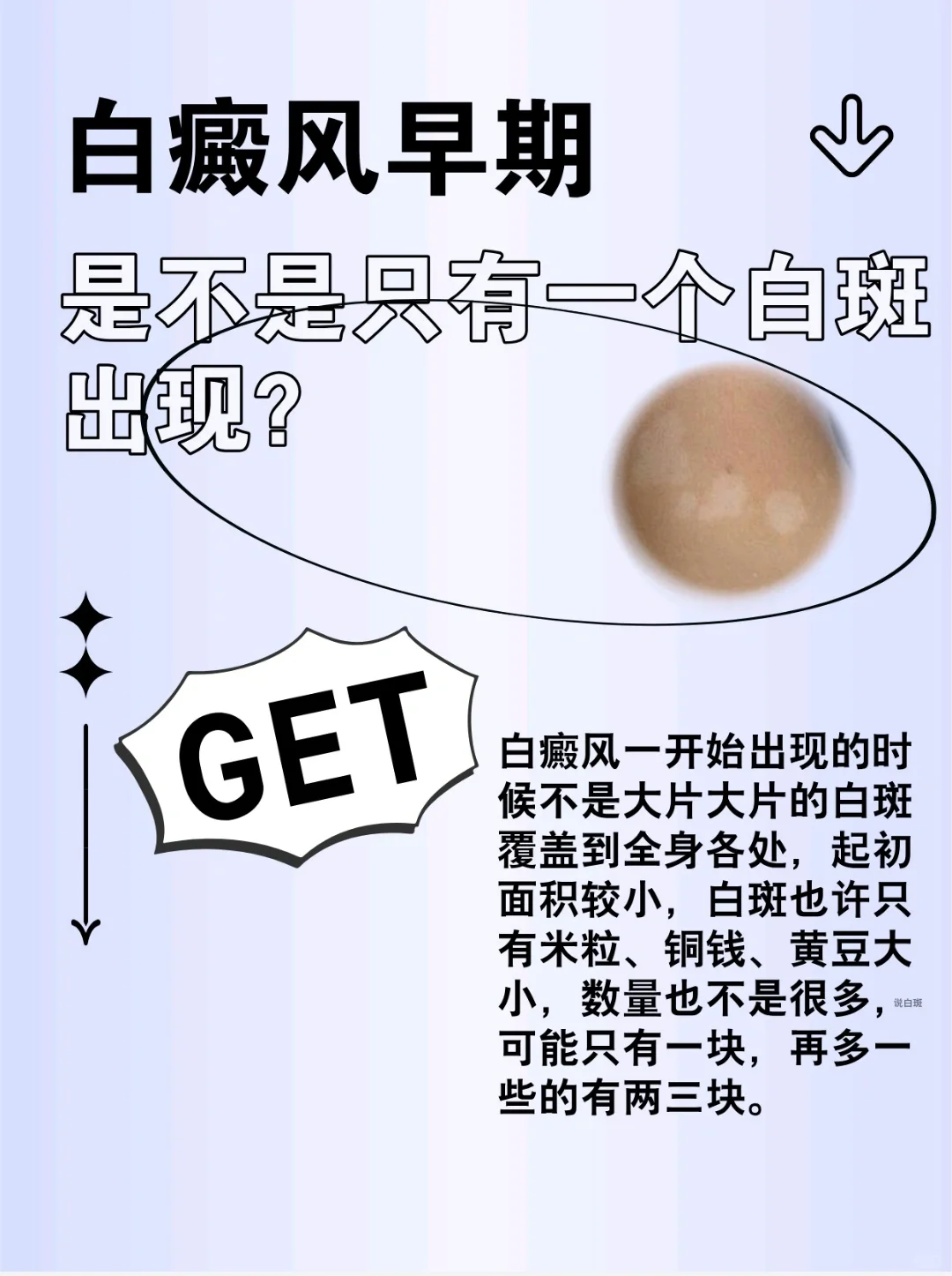 白癜风早期，是不是只有一个白斑出现？