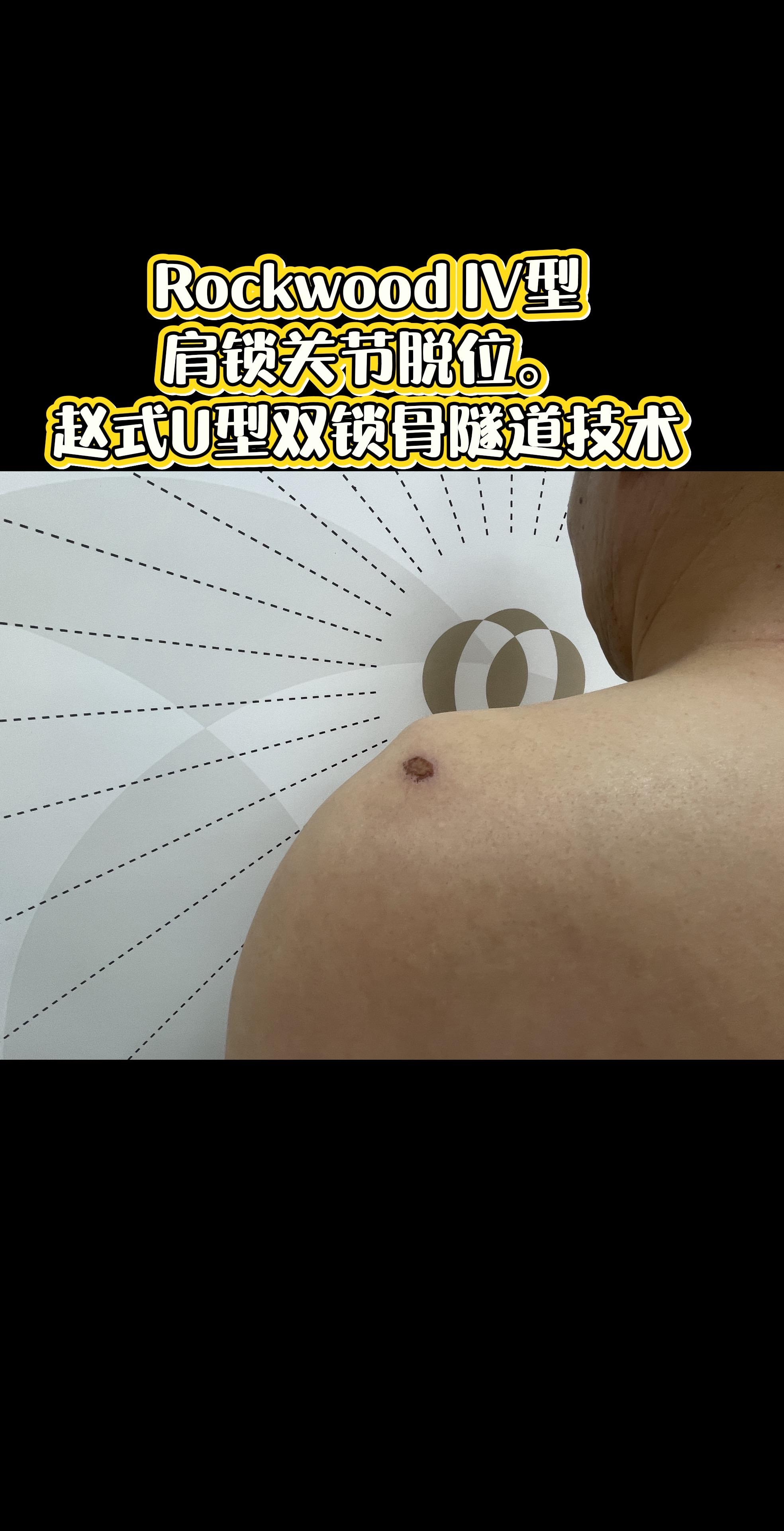 肩锁关节脱位。手术台上的每一次突破，都离不开前辈的倾囊相授。感谢赵立连...