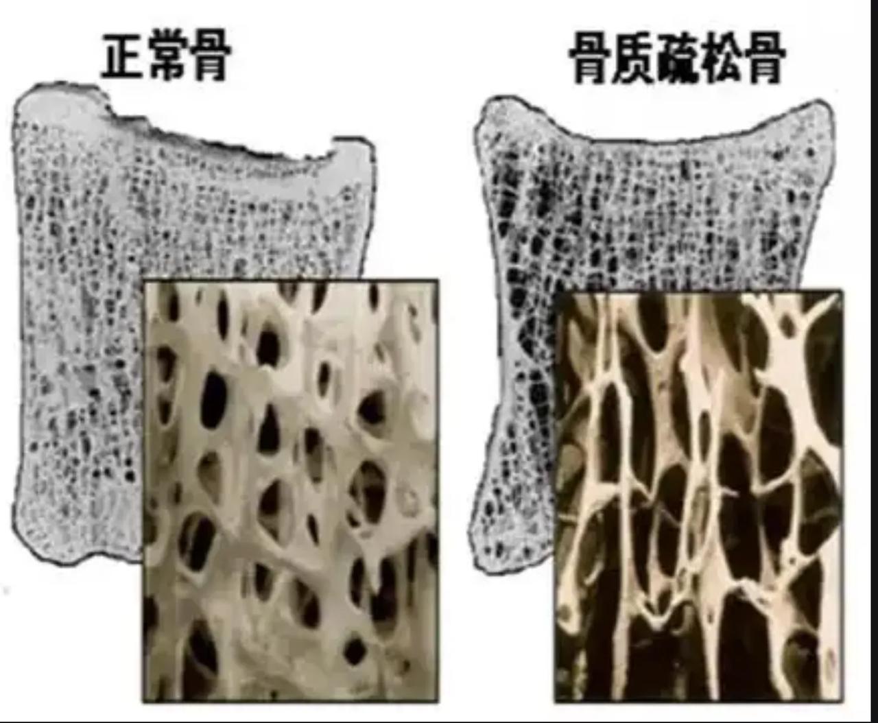 骨质疏松对于女性可能是致命的
我的姑姑年轻时长期生活在北京，年轻的时候她是个单位