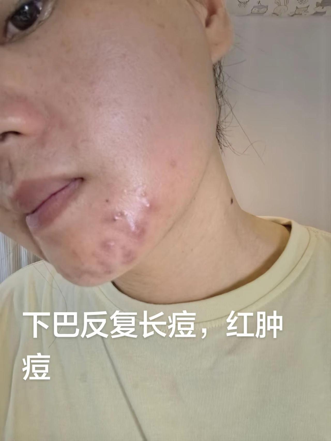 每天下班回来第一件事就是卸妆敷脸，这马齿苋真是太好了，消炎效果一级棒有的姐妹说敷