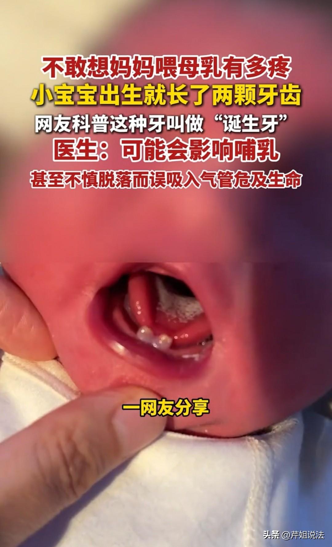 广东，小宝宝出生的时候就有两颗牙齿，大家说这种牙齿有危险，因为是松动的，万一掉入
