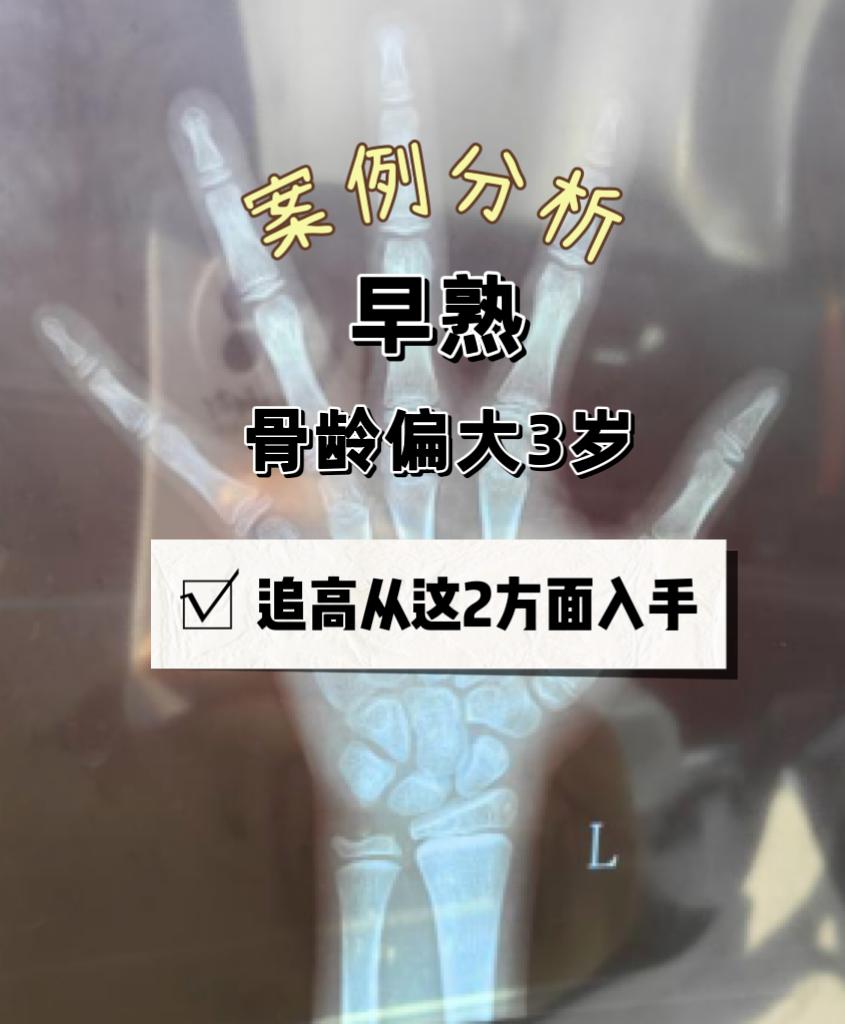 【早熟追高案例】女孩7岁半，已经胸部发育，骨龄10岁半，身高132cm，对于骨龄