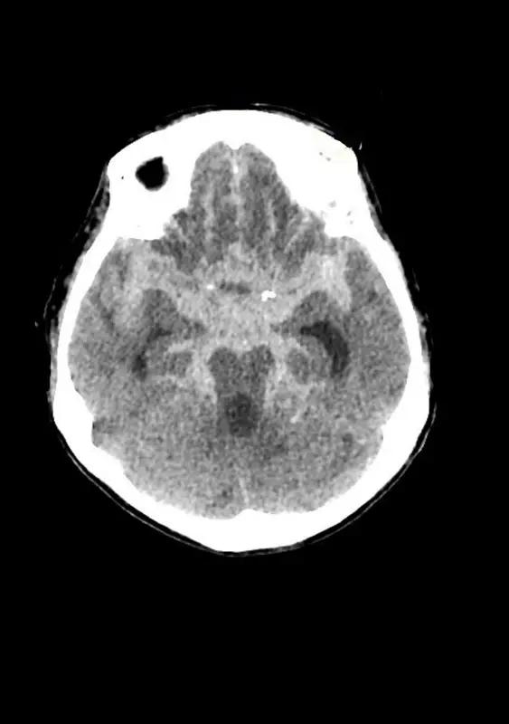 内蒙古包头这起“右脑出血开左脑”事件太离谱了。2023年1月，53岁的王先生右脑