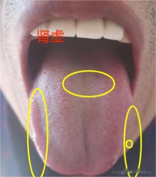 舌中有裂纹？舌两边还鼓胀？是肾虚？但是补了肾？还上火怎么办？
我们先看这个粉丝的