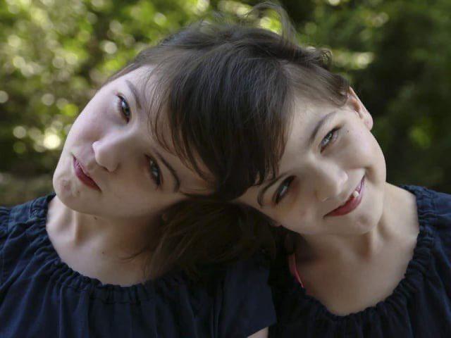 “头颅连胎”连体双胞胎，真正意义上的“形影不离”

克里斯塔·霍根（Krista