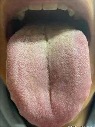 这种舌象，不管阴虚再严重，上火越厉害，也不能急着补！纯‘瞎’胡闹
主诉：这几天嘴