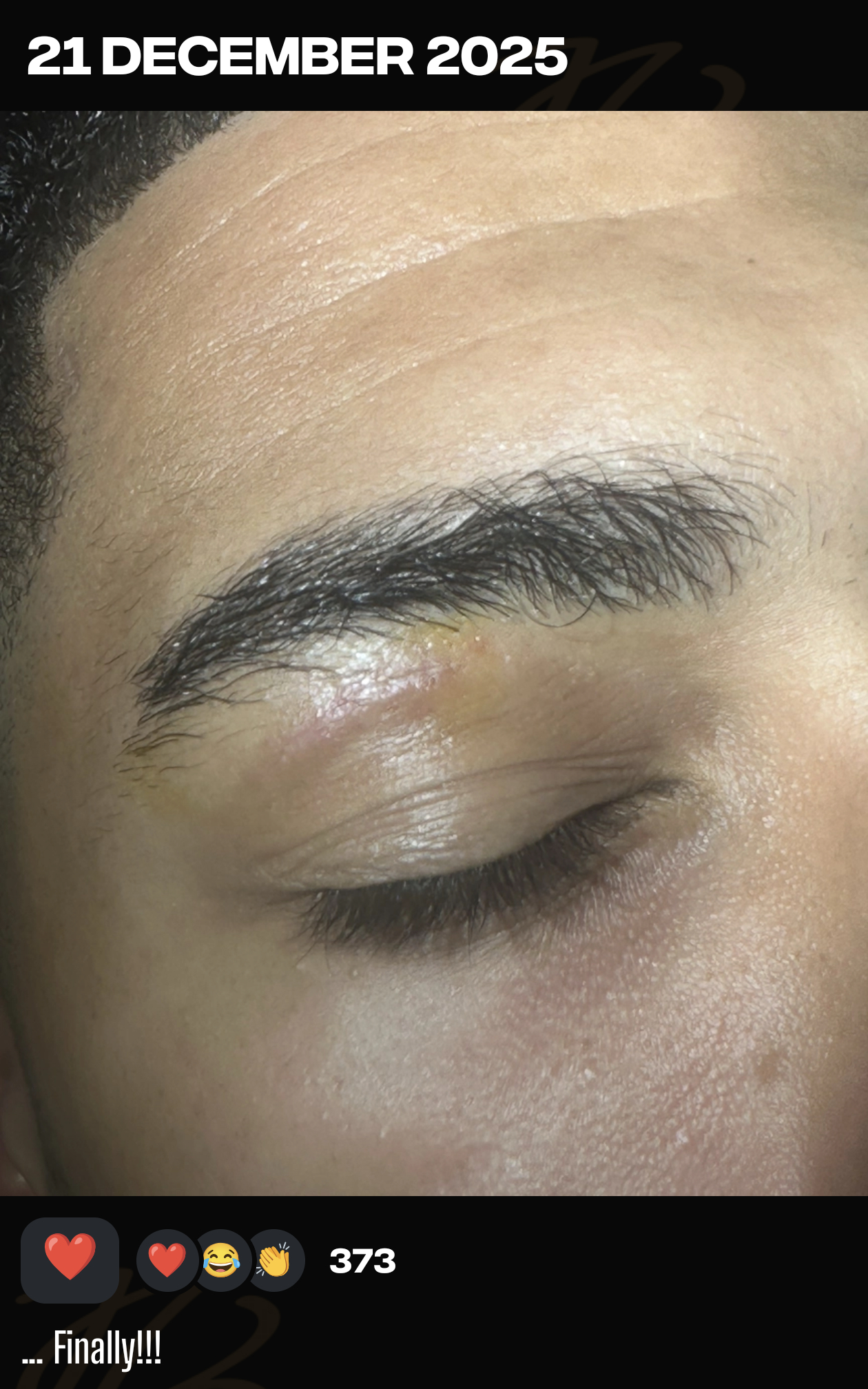 向大家汇报眼睛的恢复情况贝林厄姆