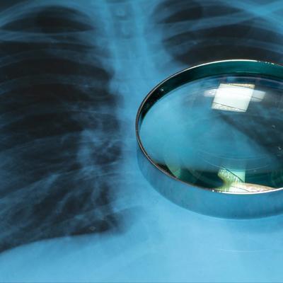 关于特发性肺纤维化新药奈米司特全部信息（三）——药物疗效对比

奈米司特 vs 