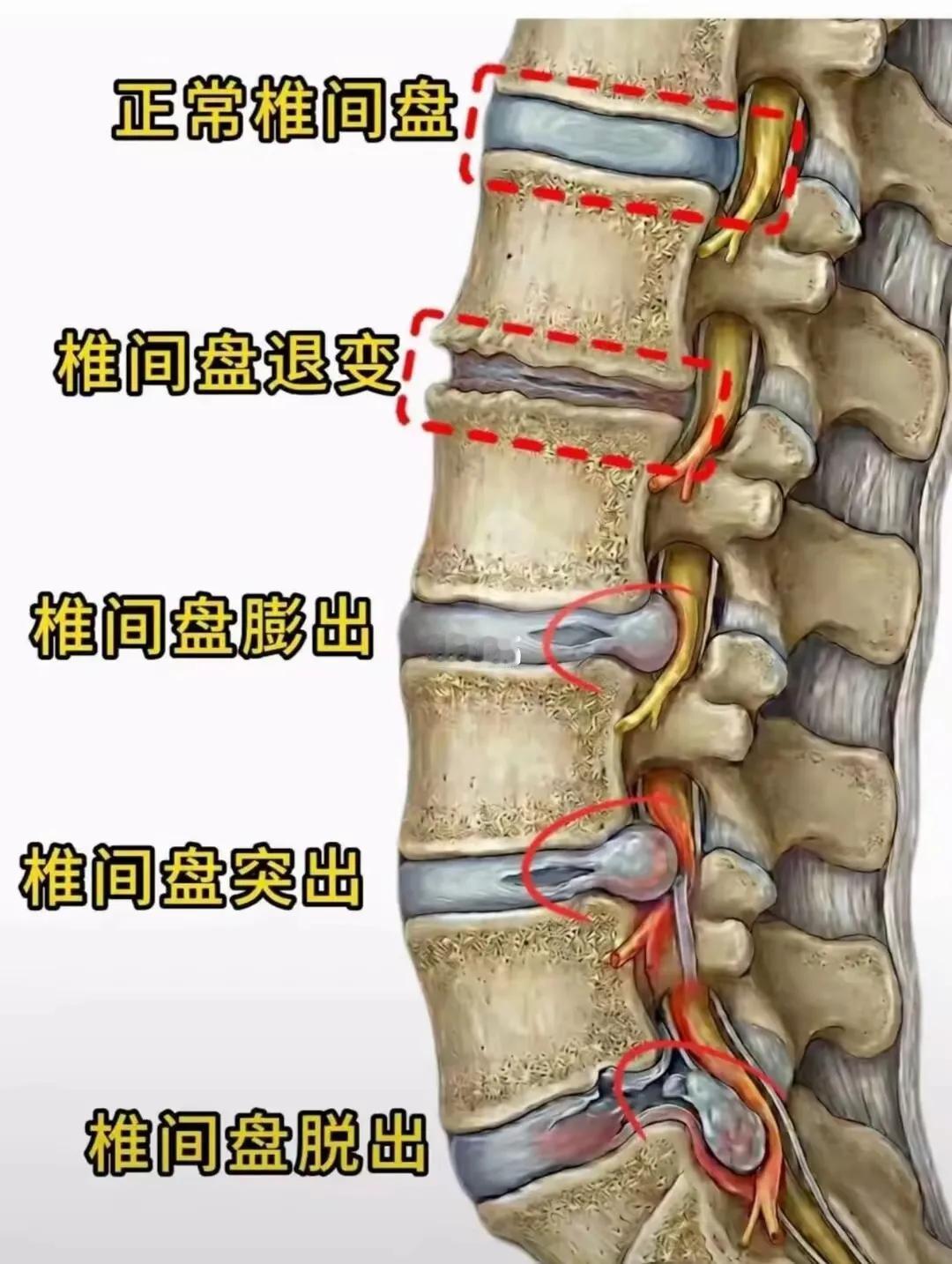 清晰明了，一图展示腰椎关节疾病的区别，按程度有退变、膨出、突出、脱出。其典型症状