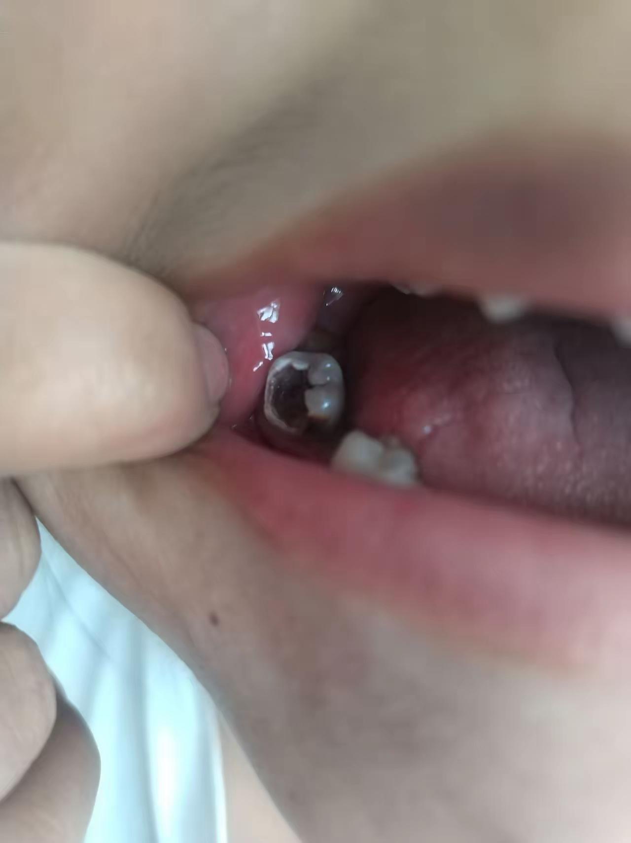 以前很少听说给婴儿刷牙的，特别是才一岁的孩子，牙刚刚长出来几颗，甚至没有长硬，哪
