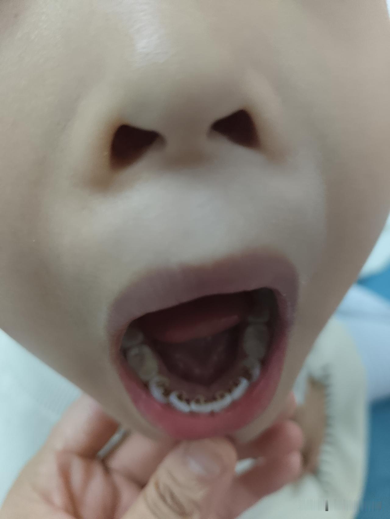 这是蛀牙吗，三岁小孩牙齿里面这么黑，用什么牙膏推荐下