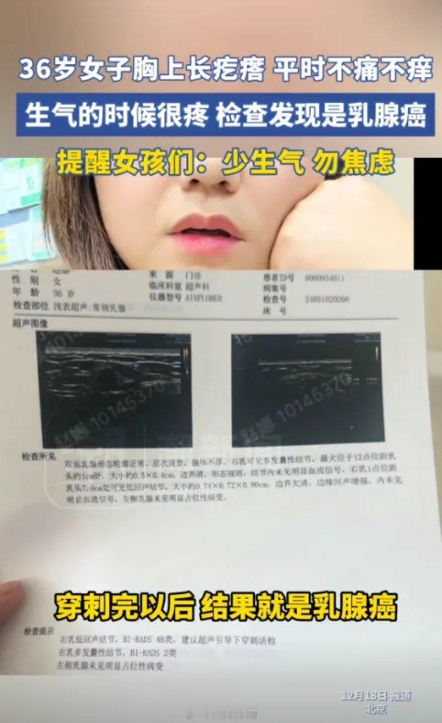 北京36岁女子胸上长了三个硬疙瘩，平时不疼也不痒她也没有太在意，直到后来因为一些