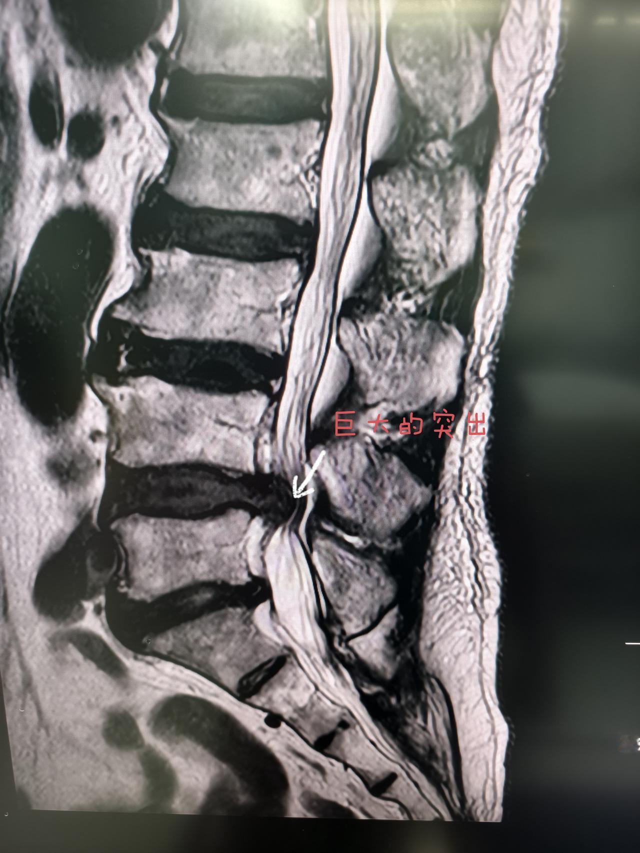 腰椎间盘突出症要不要做手术?
 绝大多数患者不需要手术，优先保守治疗：卧床休息、