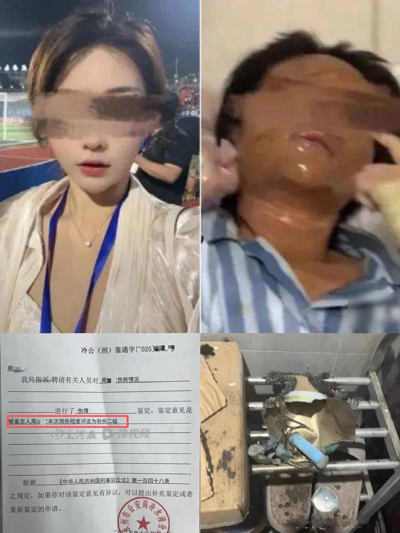 29岁女主播被伪装快递烧伤，嫌疑人已被批捕！
鉴定为轻伤二级，已申请二次鉴定！
