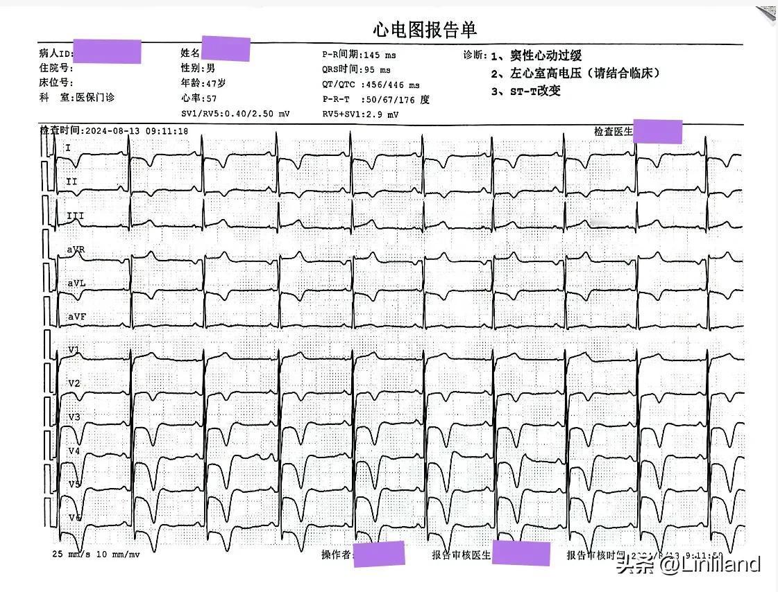 心尖部肥厚性心肌病心电图1例。

患者男性，47岁，有高血压病史10多年，平素偶