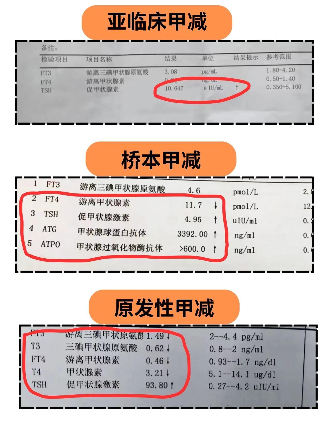 甲减常见这3种，你是哪一种 1、亚临床甲减 2、桥本甲减 3、原发性甲减