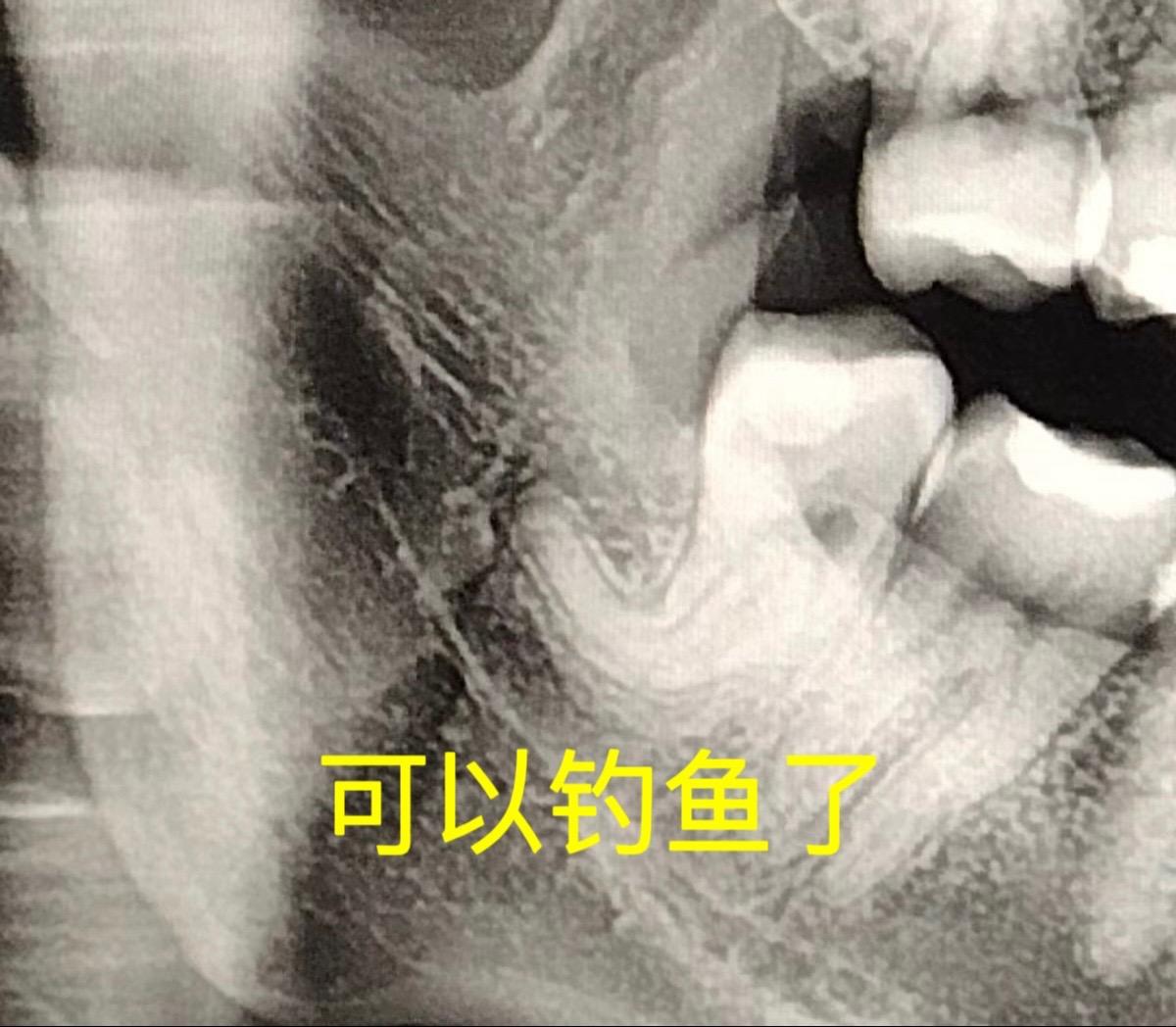 又来钓鱼钩智齿。一例粗壮的磨牙后管及CBCT的重要性： 患者朋友只有一...