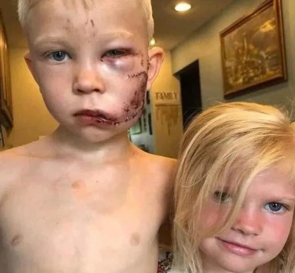 2020年，美国一小男孩从一只牧羊犬口中救出了小妹妹，因此缝了90针，但把他三岁