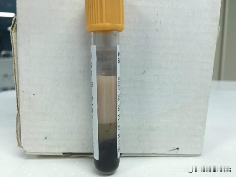 惊爆！32岁女子血中抽出“黄油”，医生：全因饮食所致！
“天呐！见过抽血，没见过