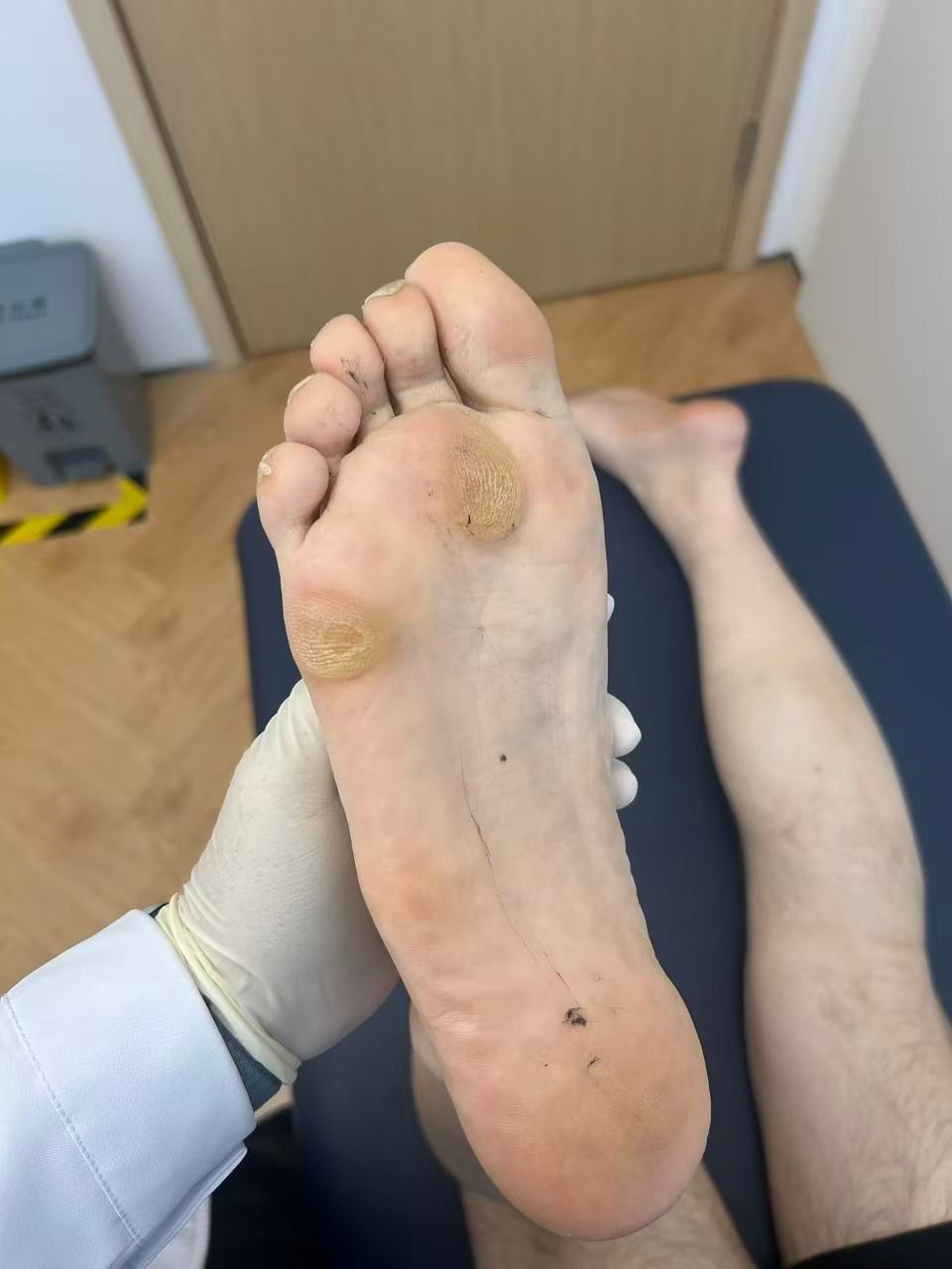 前两天我接诊了一位患者，脚上的茧真的非常典型了，在小脚趾和二三脚趾的下方，可以来