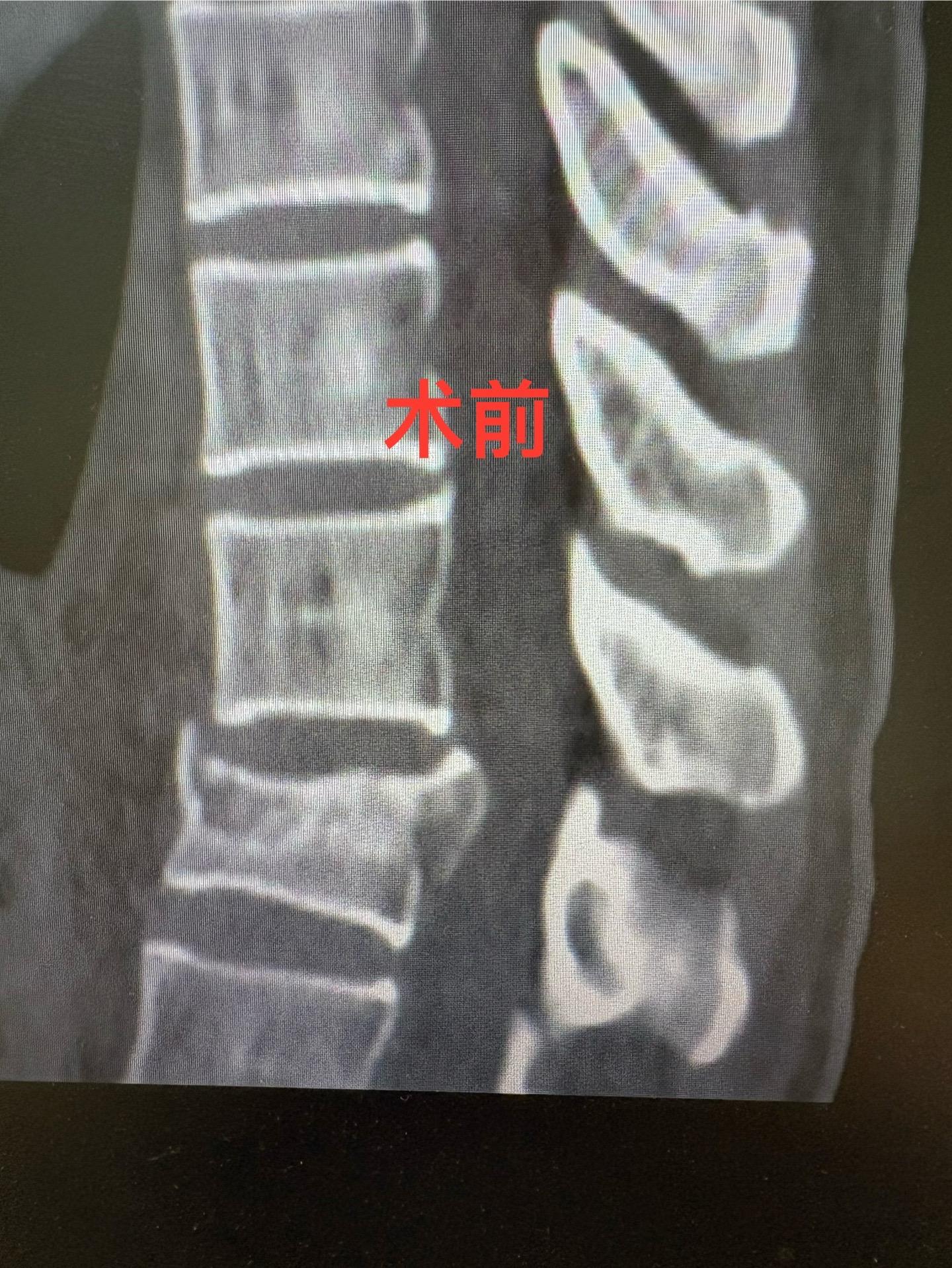 胸12爆裂性骨折，有下肢麻木症状，选择微创经皮置钉闭合复位，术后骨折复位位置满意