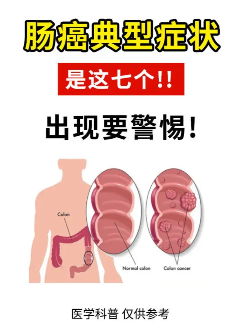 肠癌典型的7个症状，要警惕！