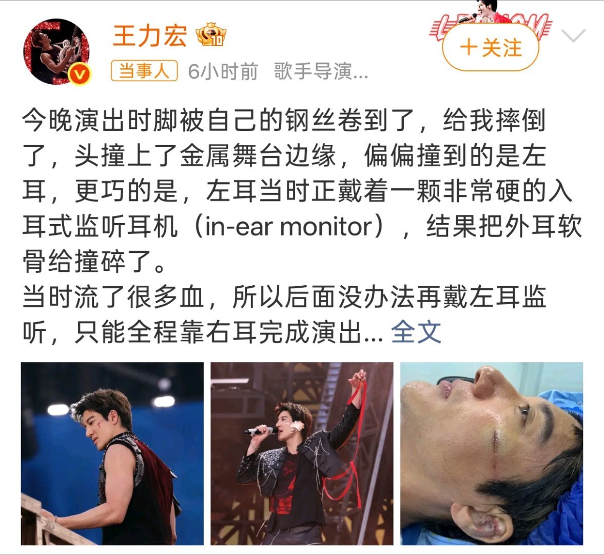 王力宏缝了39针这看着就疼，刷到了摔倒的视频，真的很重。起来之后还是继续演出。而