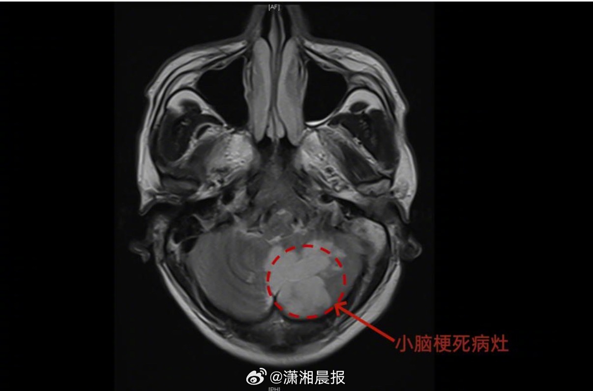 【52岁#男子AI问诊以为患眩晕症实际是脑梗#】如今，身体不适后先上网搜索、咨询