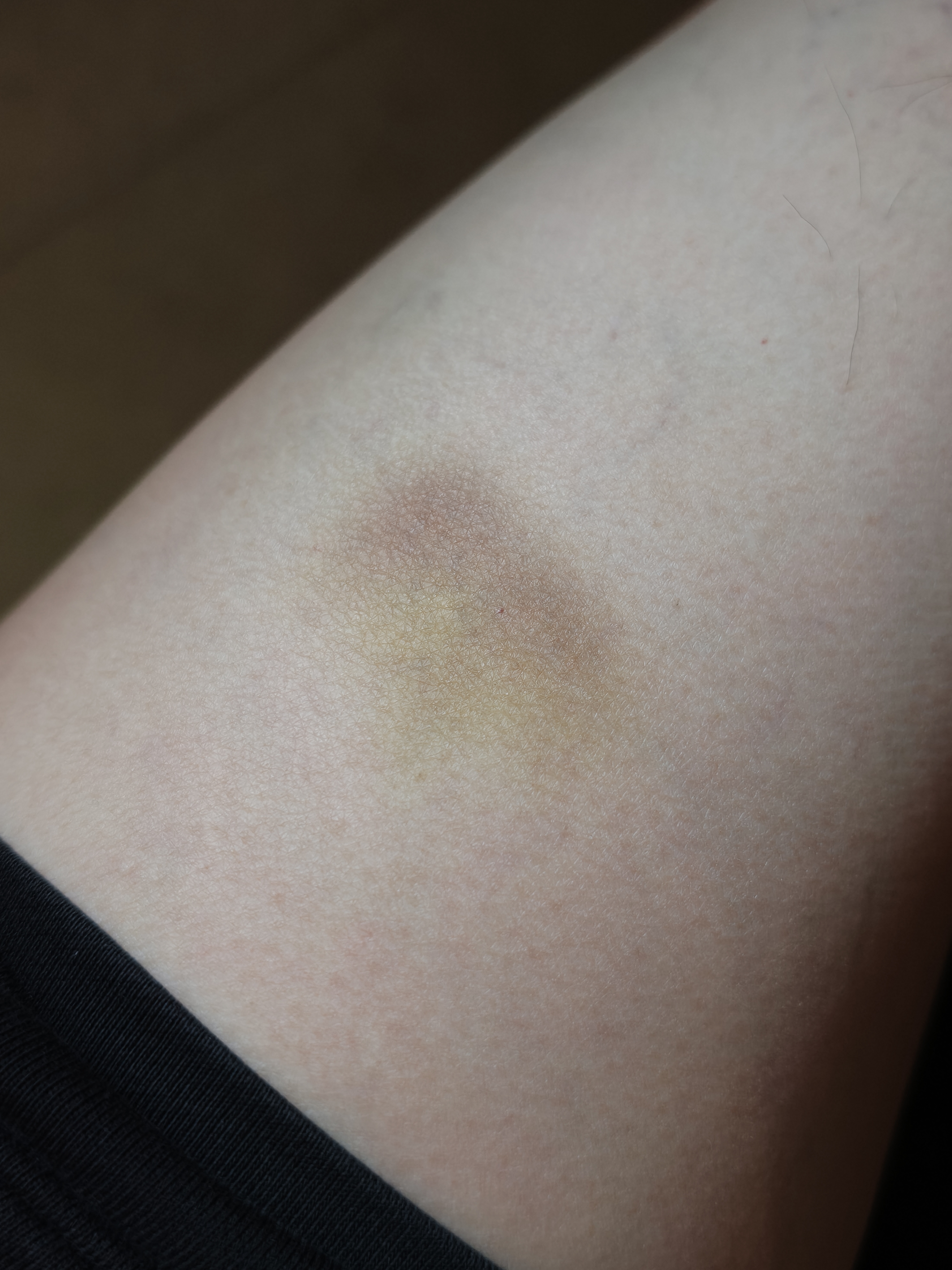 周六踢球又被球打出了一块淤青。。。好吧，目前还没青 